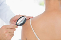 Descubren que el melanoma altera el metabolismo de todo el cuerpo a nivel molecular