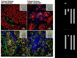 El &aacute;cido palm&iacute;tico promueve la met&aacute;stasis del c&aacute;ncer, seg&uacute;n un estudio